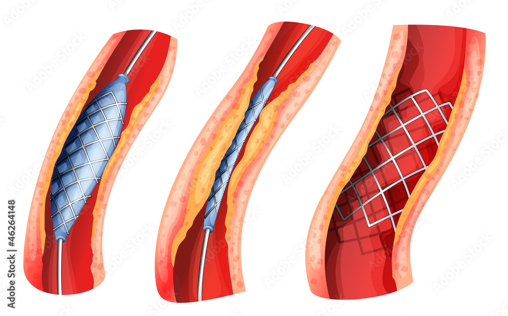 用于打开阻塞动脉的支架