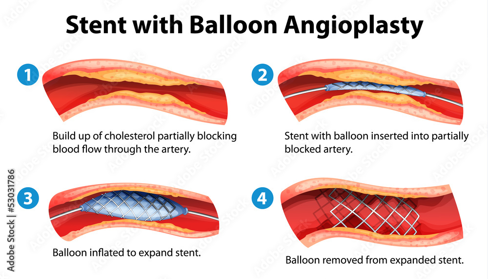 Stent angioplasty procedure