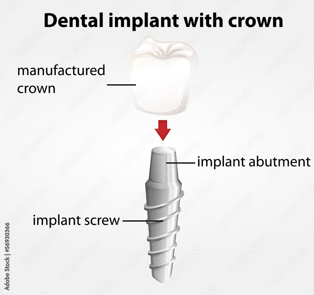 带牙冠的牙科植入物