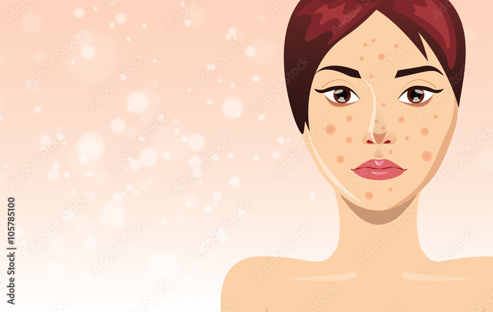 Acne treatment= with beautiful woman face, vector illustration