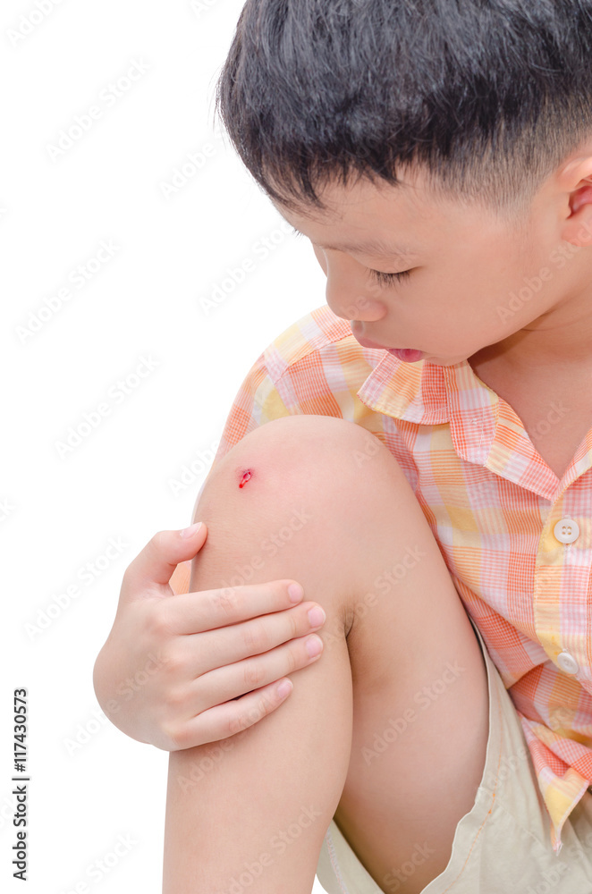 Young asian boy with wound on the knee