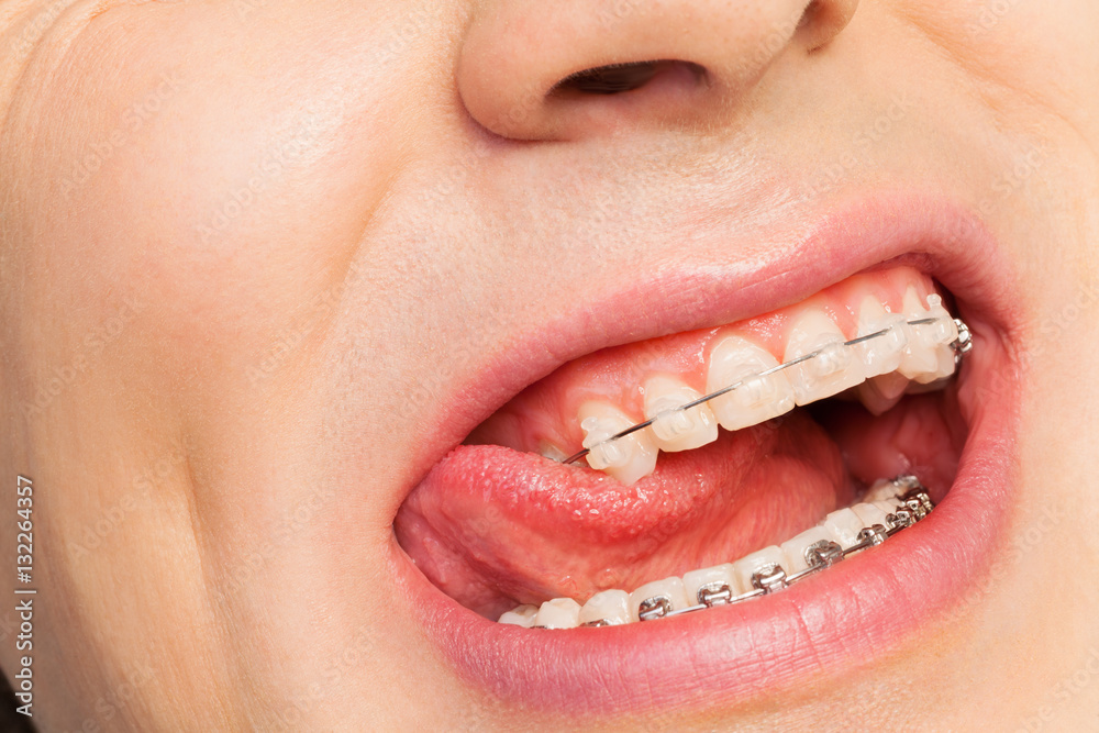 Man licks his teeth with orthodontic cases