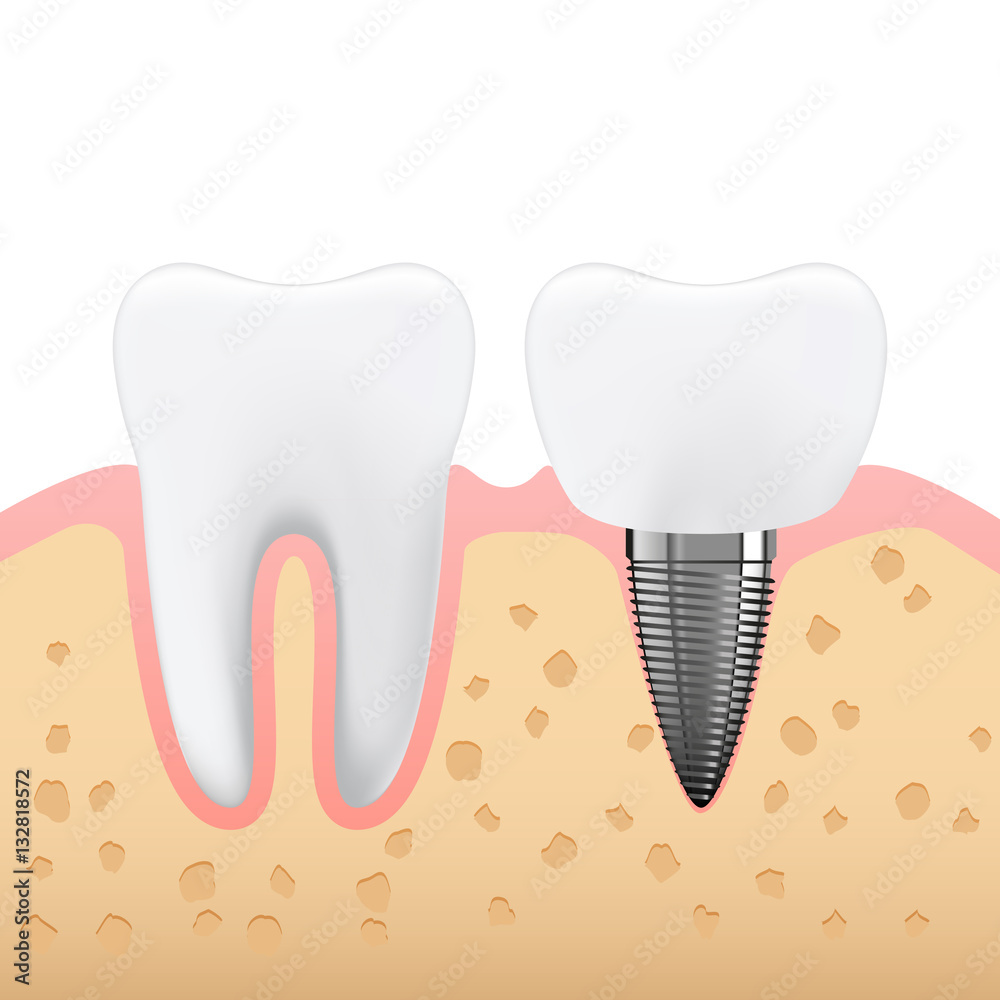 Schematic illustration of dental prosthetics, denture, side view