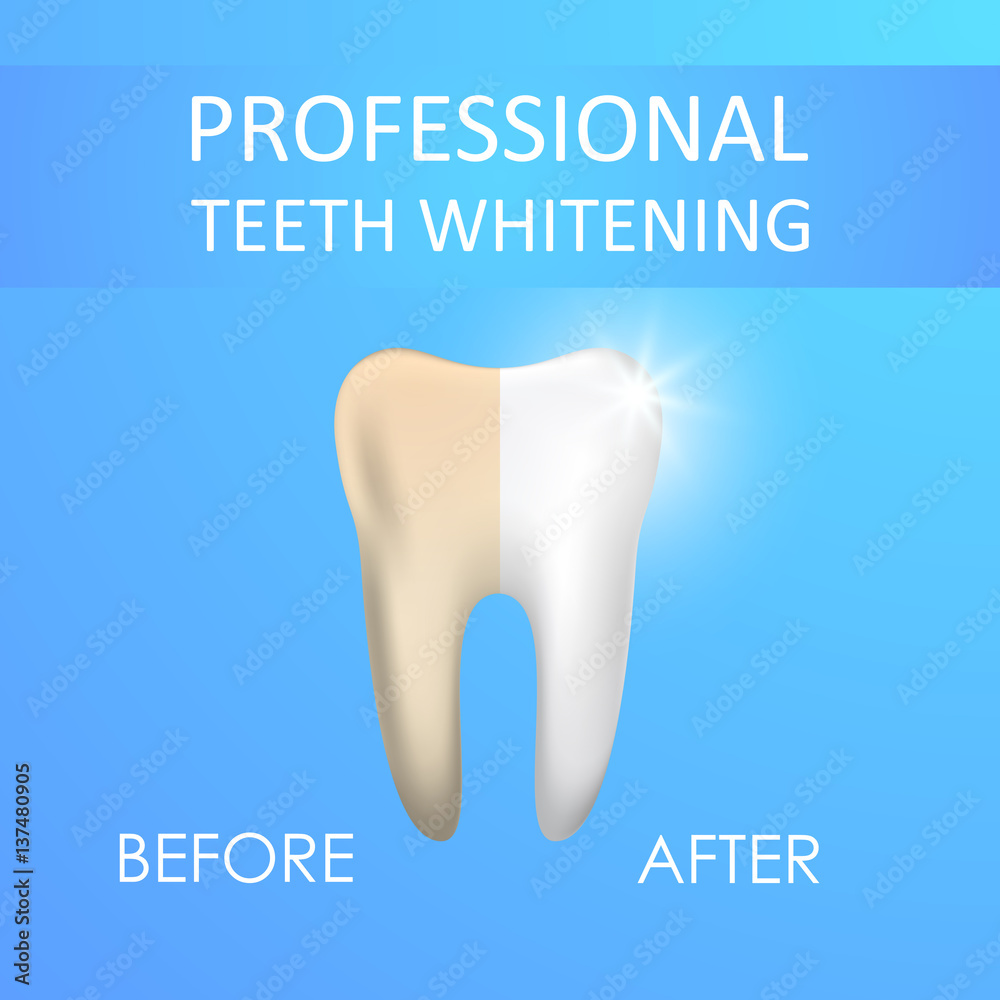 Professional Teeth Whitening, Healthy and yellow Tooth, vector illustration