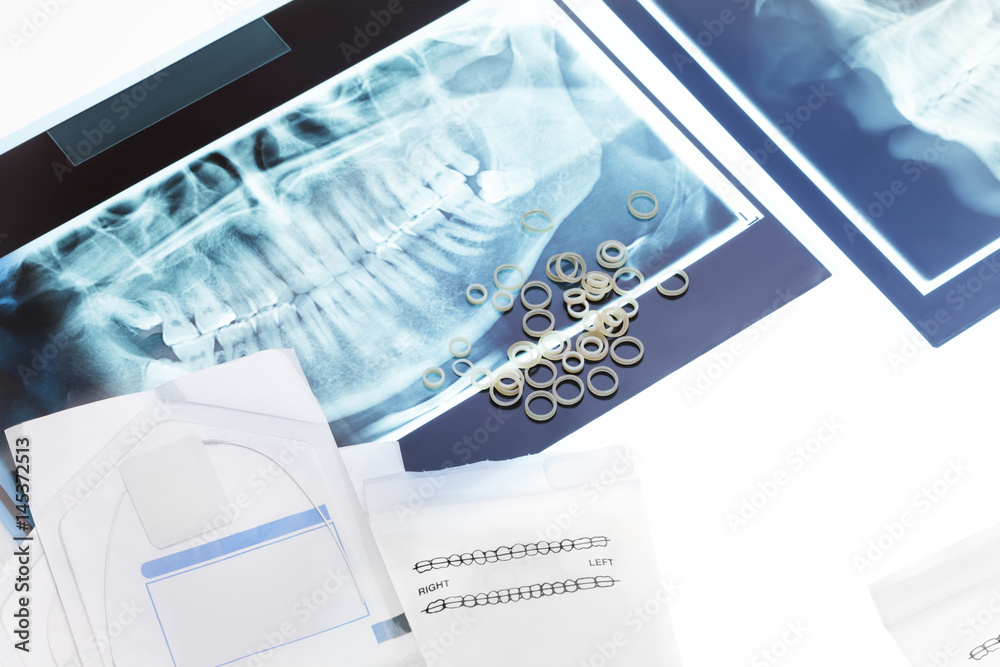 Orthodontic tools and xray on the table