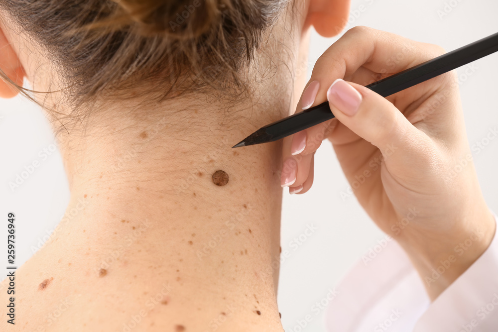 Dermatologist applying marks onto patients skin before moles removal, closeup