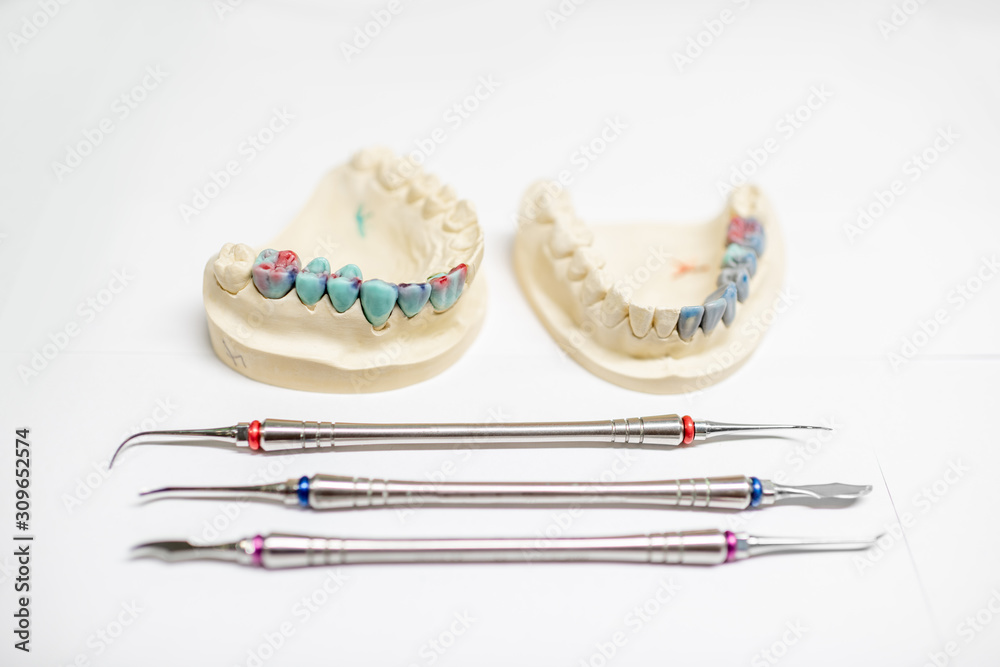 Plaster models of artificial jaw with painted dental prosthesis on the white background. Concept of 