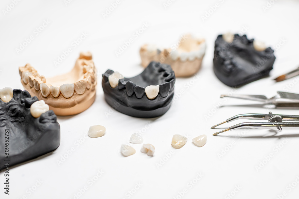 白色背景上有植入物、贴面和牙科器械的人造石膏颌模型。