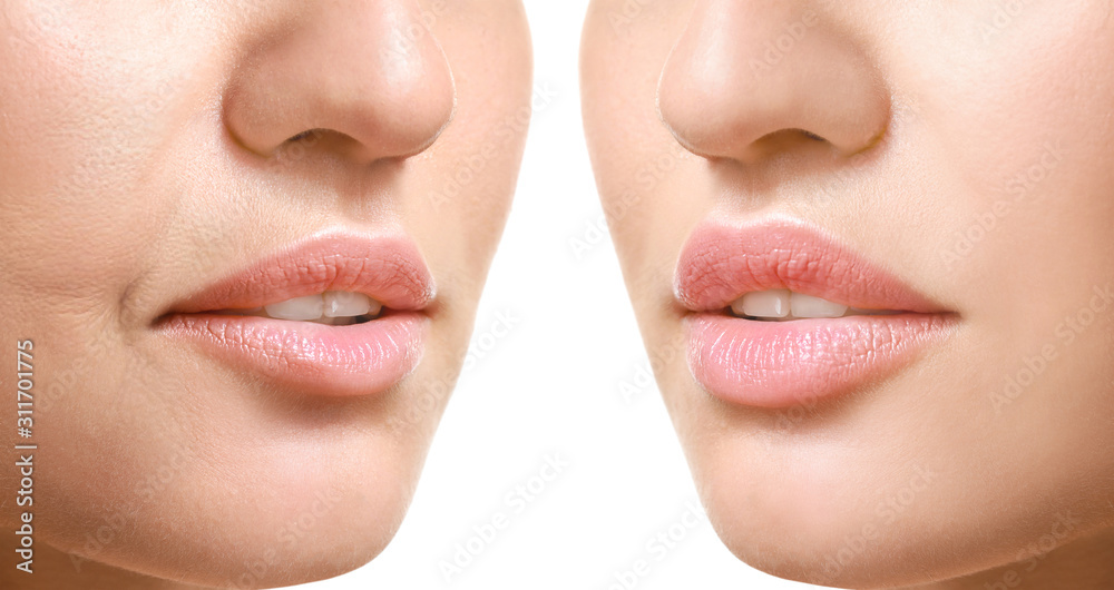 Young woman before and after filler injection on white background