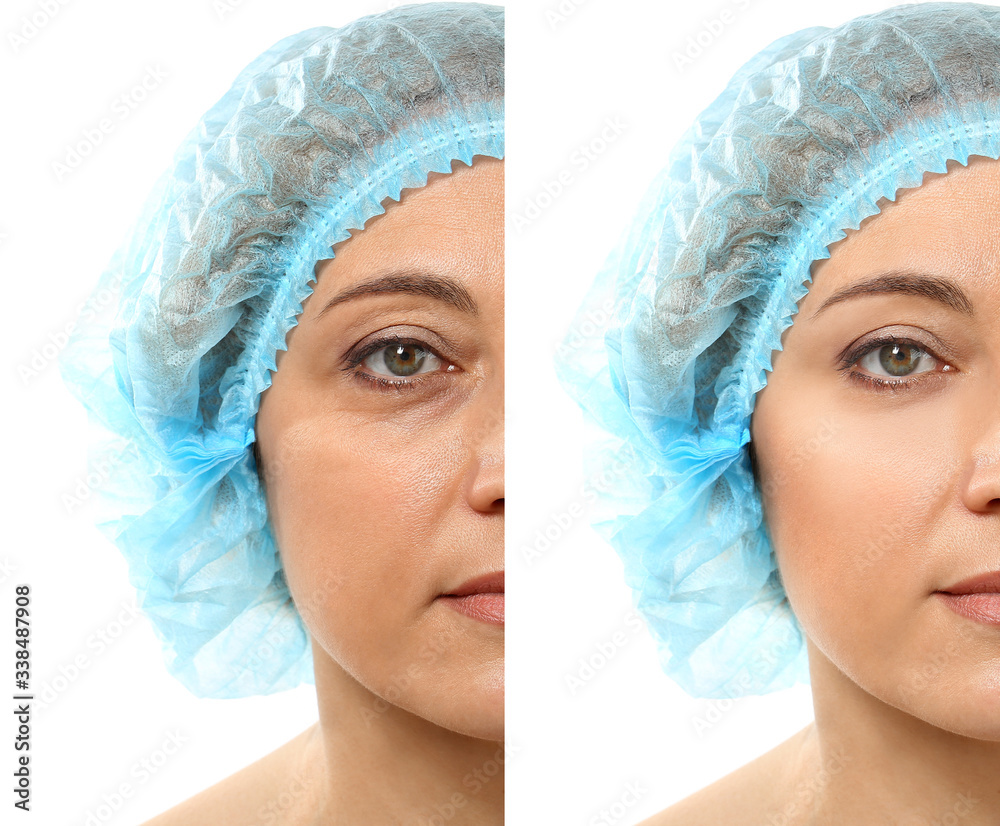 Woman before and after plastic surgery on white background