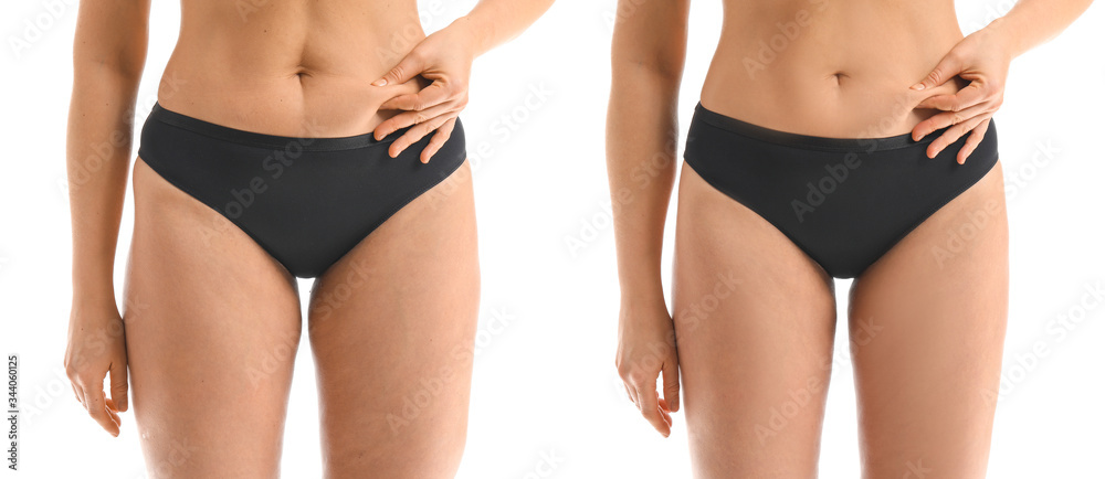 Young woman before and after anti-cellulite treatment on white background