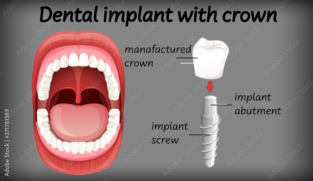 带牙冠的牙科植入物