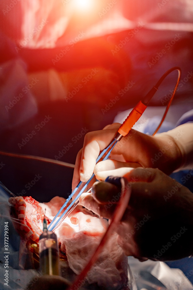 View on surgeon`s hands performing brain surgery operation. Closeup of process. Modern equipment in 