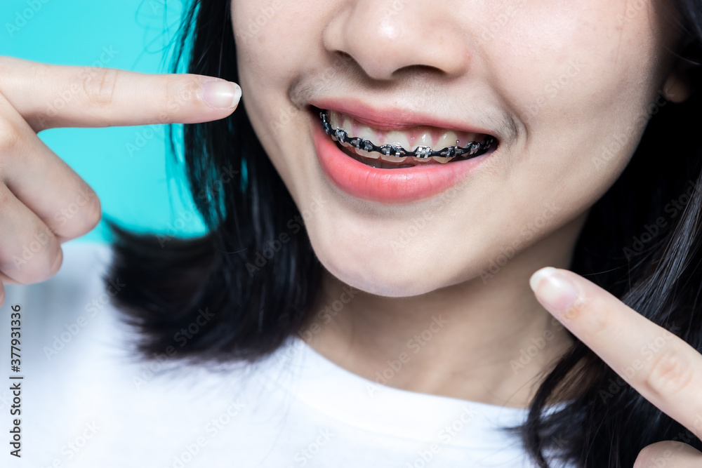 Asian woman wearing detal braces pointing to tooth sample and smiling with her healthy white teeth i