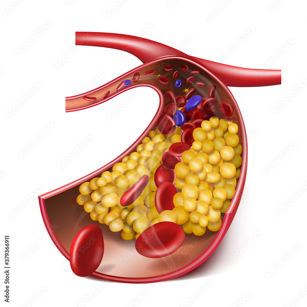 Vein with high cholesterol levels. Medical illustration. 3d vector