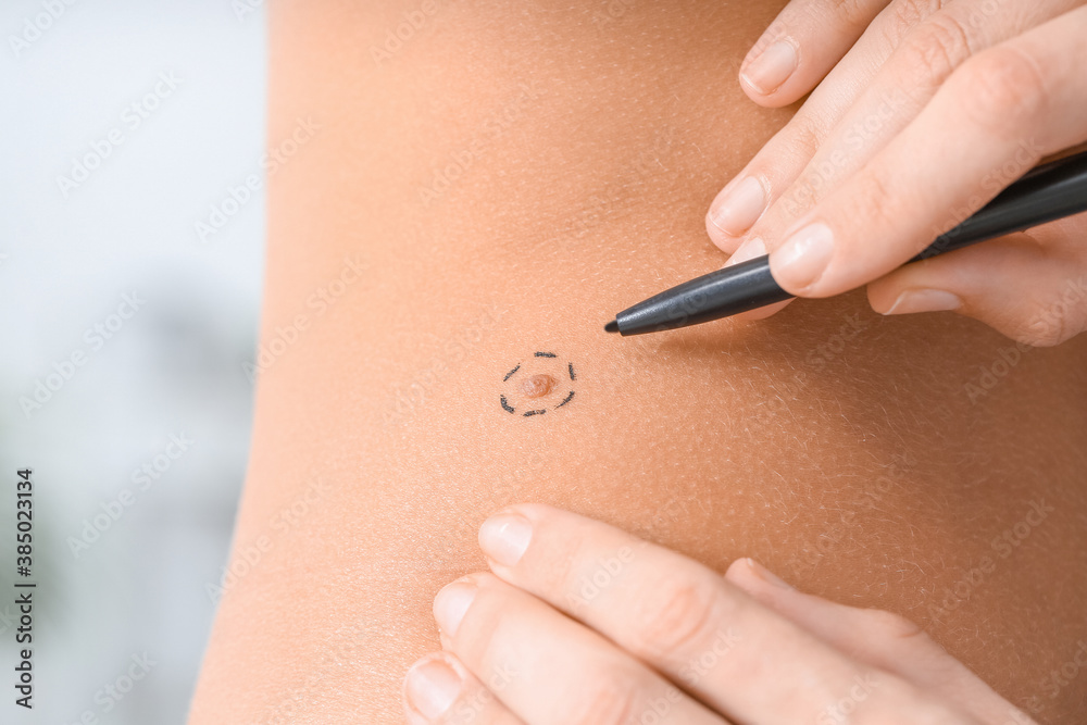 Dermatologist examining patient in clinic, closeup