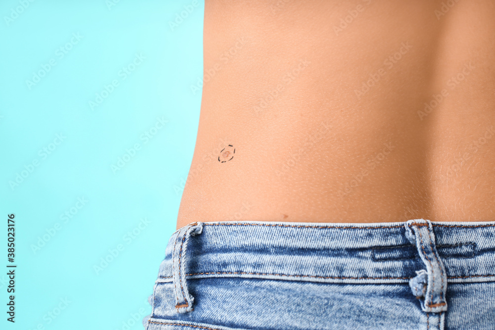 Woman with moles on color background, closeup