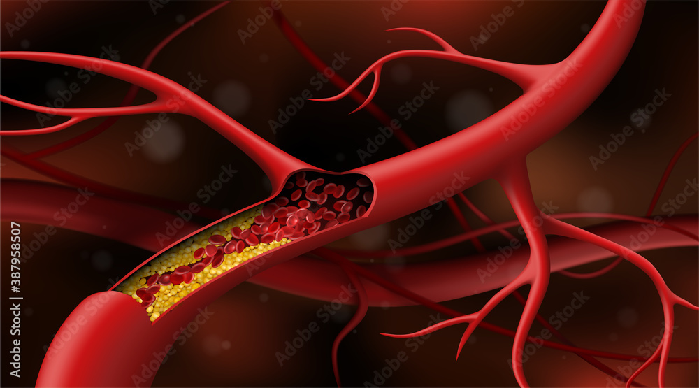 Artery blocked by cholesterol. Vector illustration