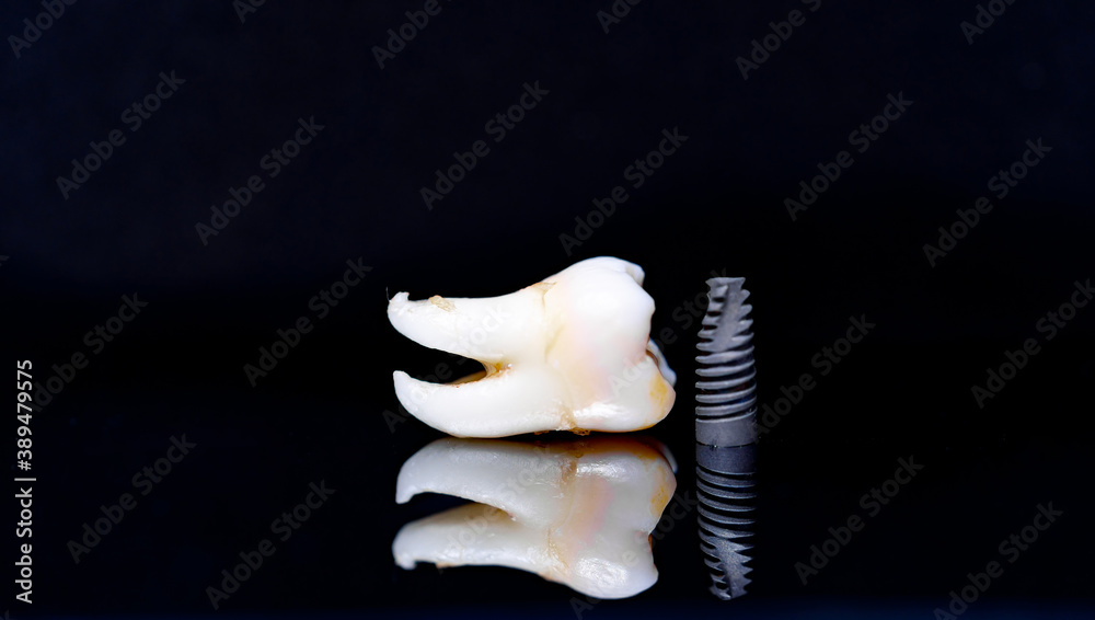 Beautiful ceramic teeth with dental post. Black mirror surface background.