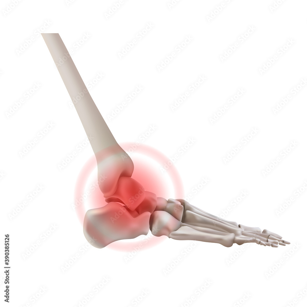 炎症性关节炎患者的脚骨。矢量图