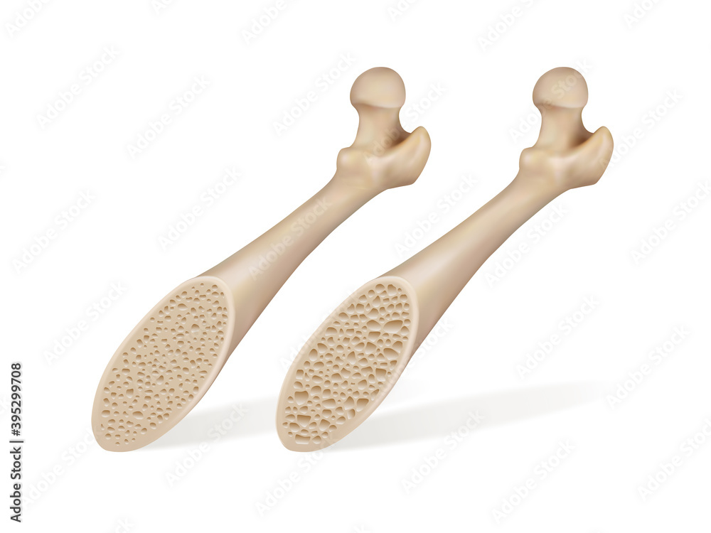 Medical illustration of healthy bone and bone of a patient with osteoporosis. Vector illustration