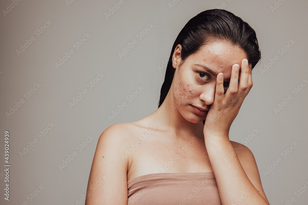 Portrait of woman with acne inflammation