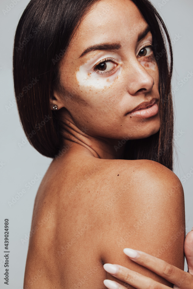 Confident woman with vitiligo