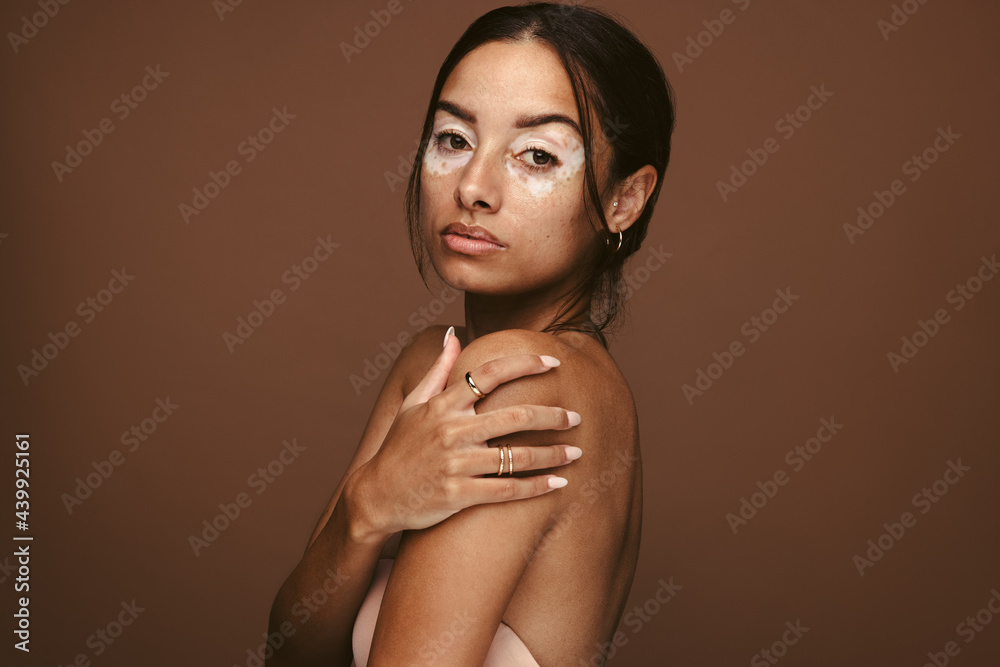 My vitiligo is beautiful