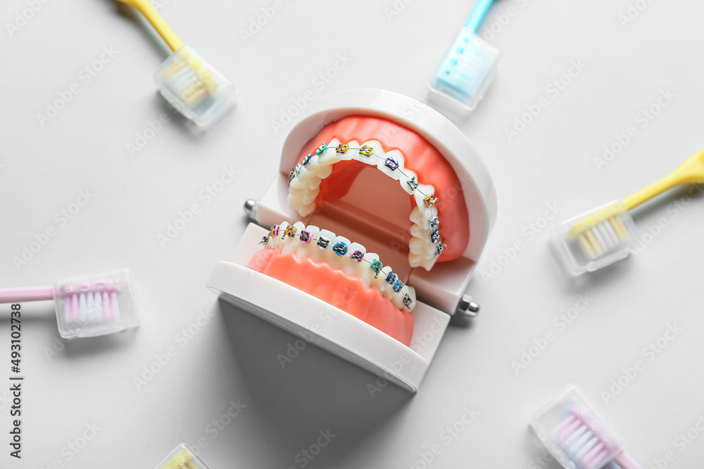 Model of jaw with dental braces and toothbrushes on light background