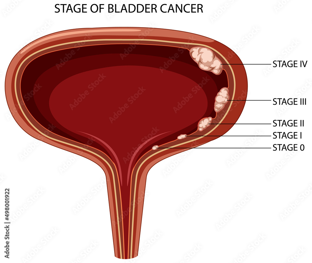 膀胱癌症期