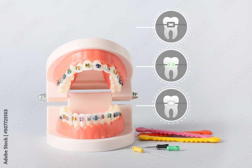 浅色背景下带牙套和牙科工具的下颌模型