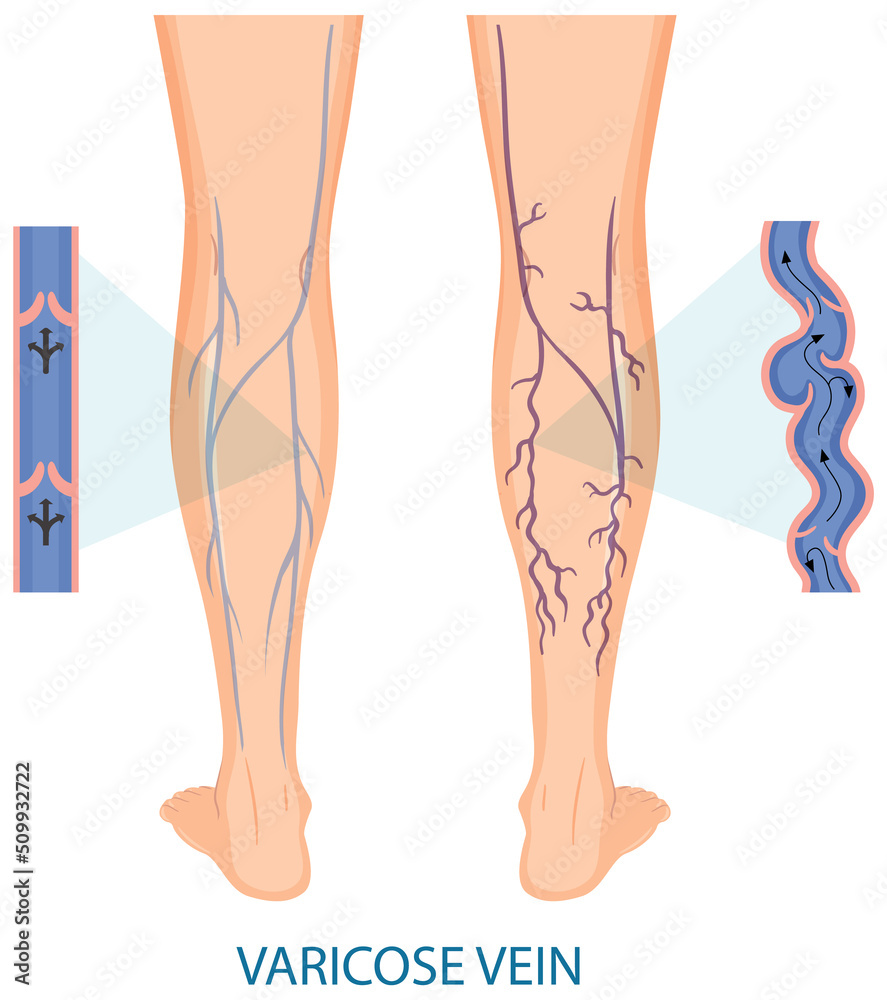 Human legs with varicose vein