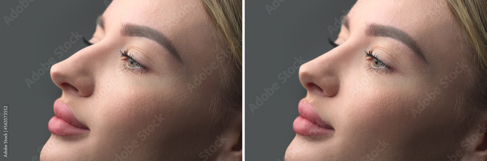 Nose Before and after plastic surgery. Rhinoplasty. Crooked nose correcting. Young woman profile por