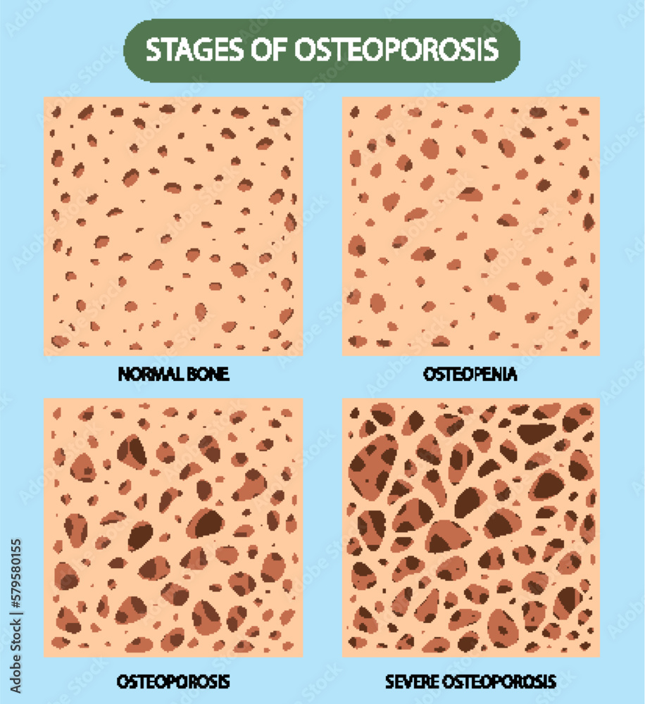 Bone Density and Osteoporosis Vector