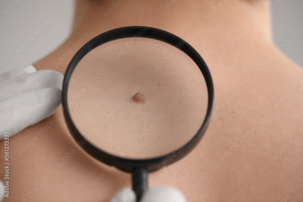 Dermatologist examining mole on young mans back with magnifier in clinic, closeup