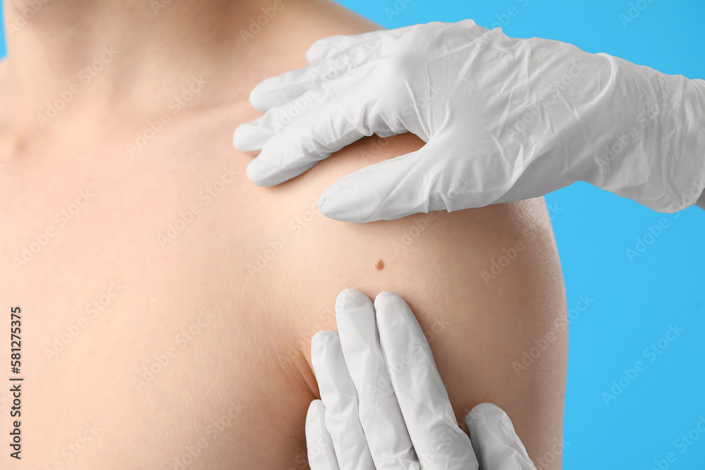 Dermatologist examining mole on young mans shoulder against blue background, closeup