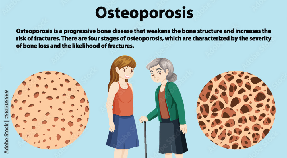 Bone Density and Osteoporosis Vector