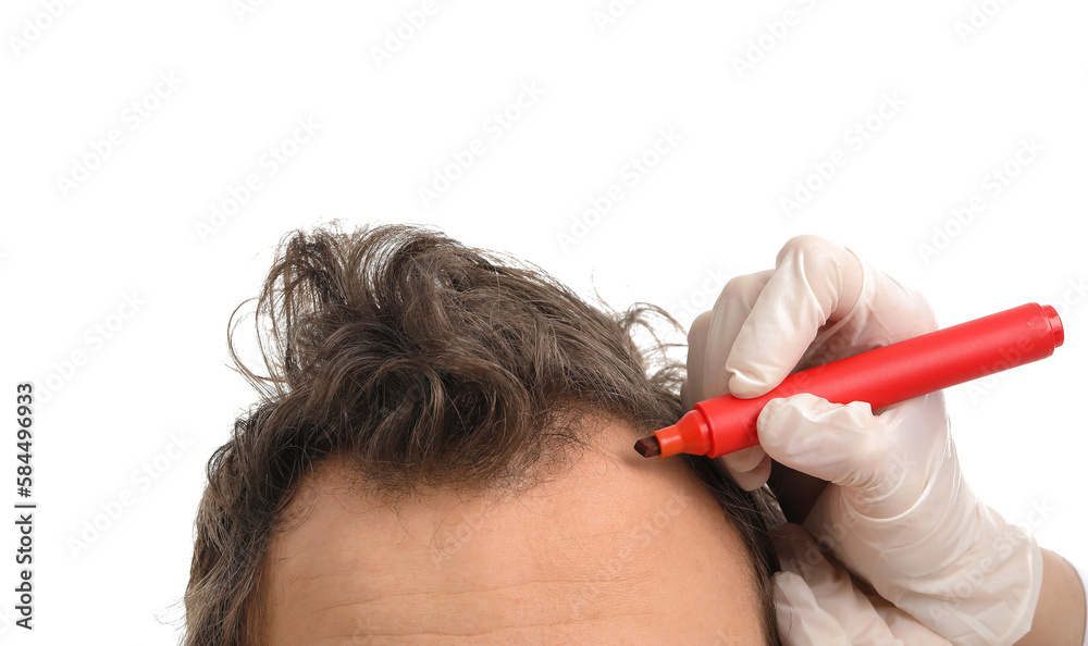 Doctor marking young mans forehead with hair loss problem on white background, closeup