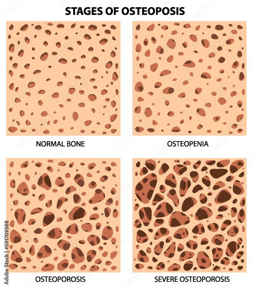 Stages of Osteoposis Vector