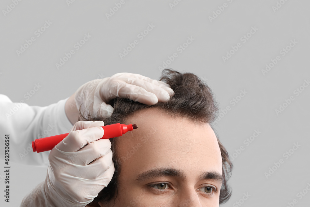 Doctor marking young mans forehead with hair loss problem on grey background, closeup