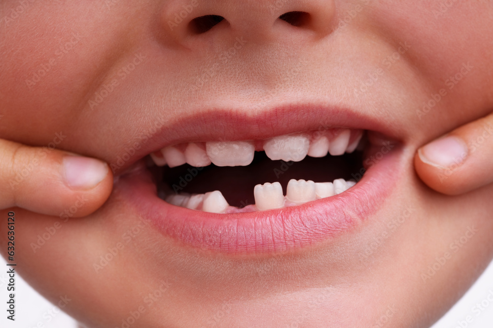 Open mouth of a child with a loose baby tooth