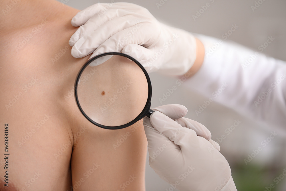 Dermatologist examining mole on young mans shoulder with magnifier in clinic, closeup