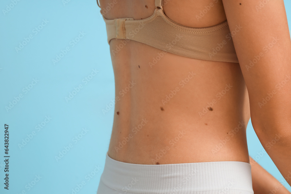 Young woman with moles on blue background, closeup